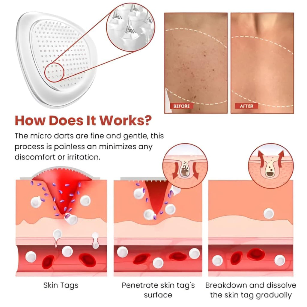 Skin Tag Remover Patch  (72 Patches)
