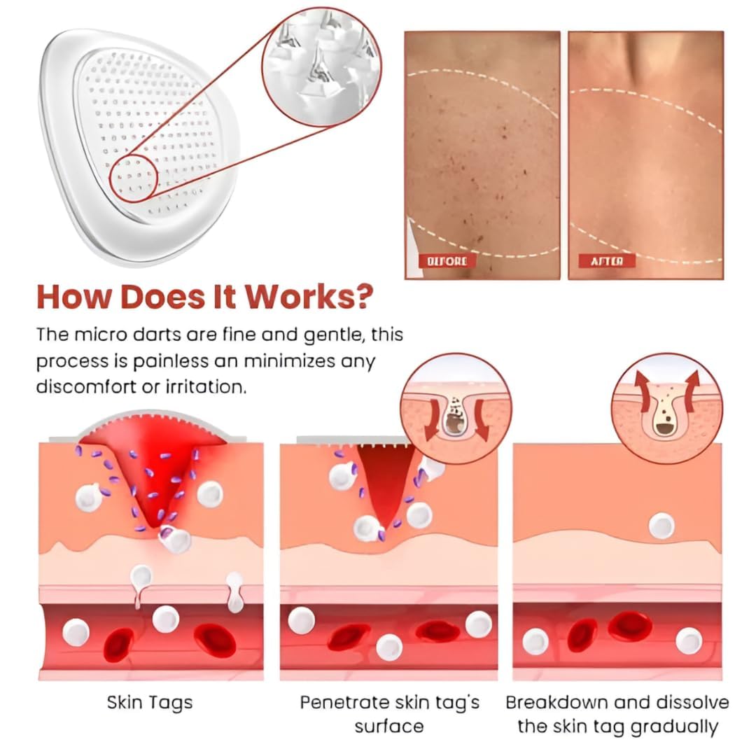 Skin Tag Remover Patch  (72 Patches)