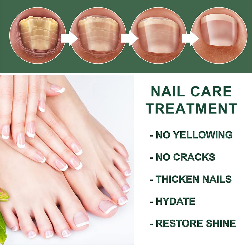 Nail Fungus Treatment Oil (Imported)