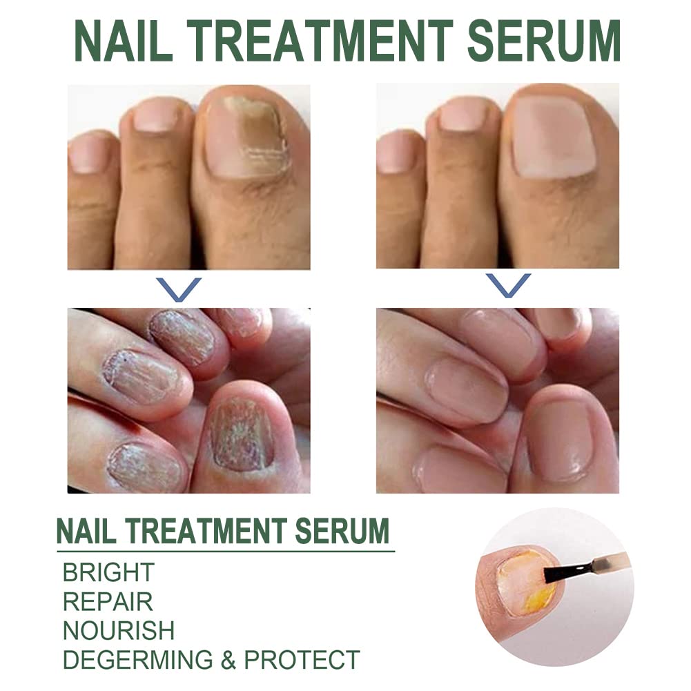 Nail Fungus Treatment Oil (Imported)