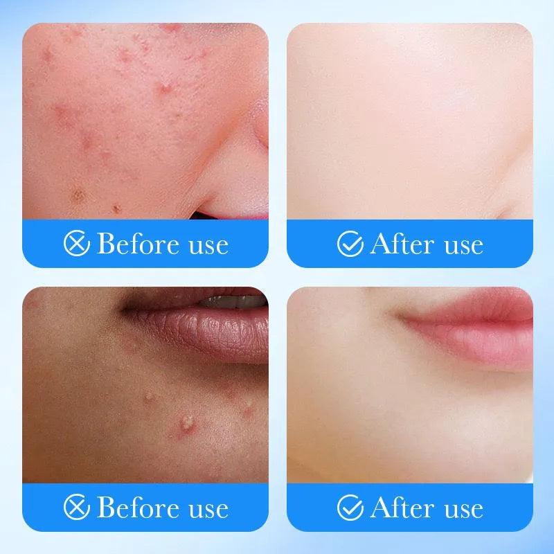 Hydrocolloid Pimple Patch